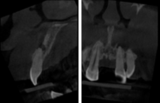 fig-02-endo-guidée