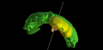 fig-05-endo-guidée