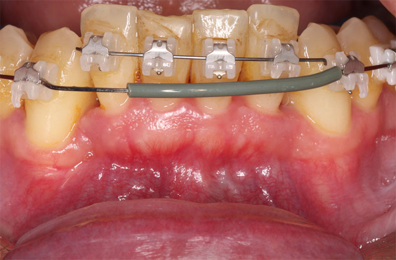 fig01-corticotomies