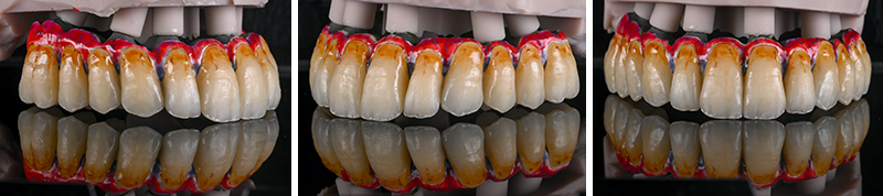 Réalisation de la prothèse d'usage barre titane et dents montées en résine usinée
