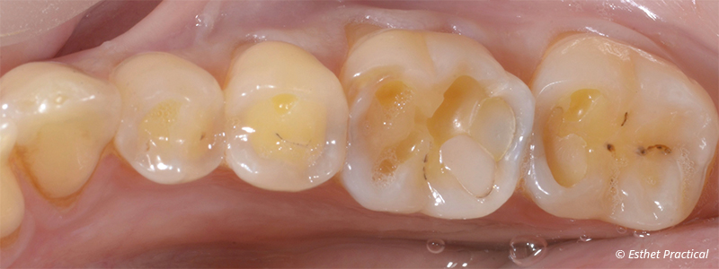 fig-04-usure