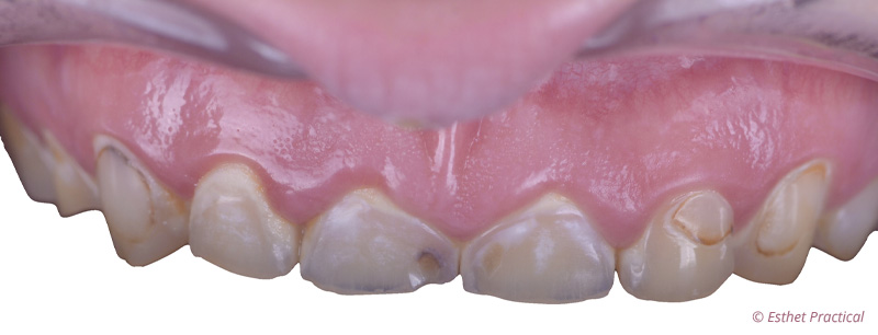 fig-05-usure