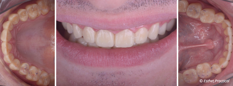 fig-18-usure
