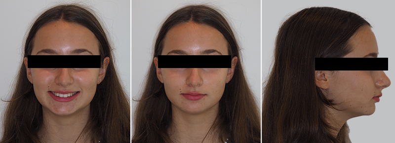 Carriere Motion®, Cas clinique