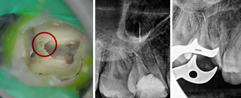 erreurs à ne pas commettre en endodontie