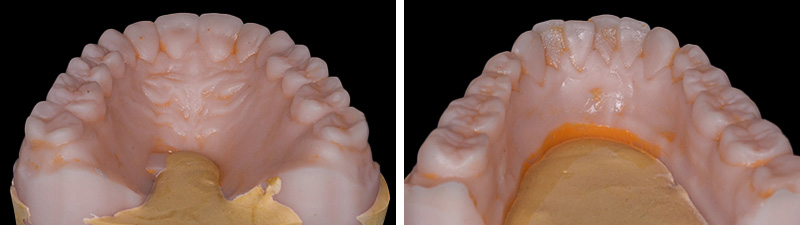 wax up numériques