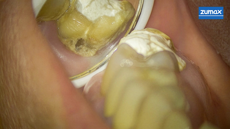 traitements endodontiques, patiente
