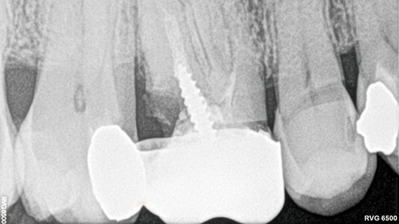 traitements endodontiques, examen