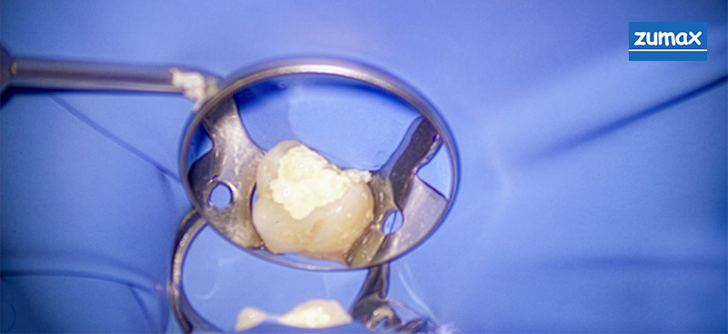 traitements endodontiques, obturation provisoire 