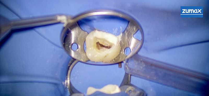 reconstitution pré-endodontique de la paroi mésiale