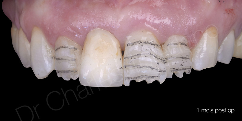 Etat après un mois de cicatrisation gingivale